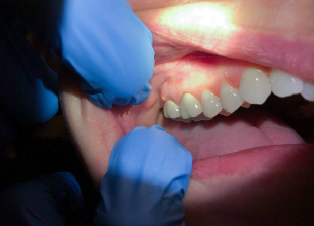 Best Emergency Denture Repair in Washington Terrace, UT
